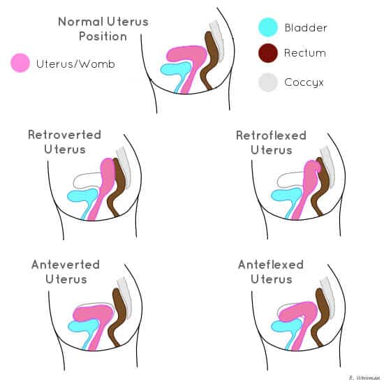 Uterus Positions Retroverted, Retroflexed, Anteverted, Anteflexed